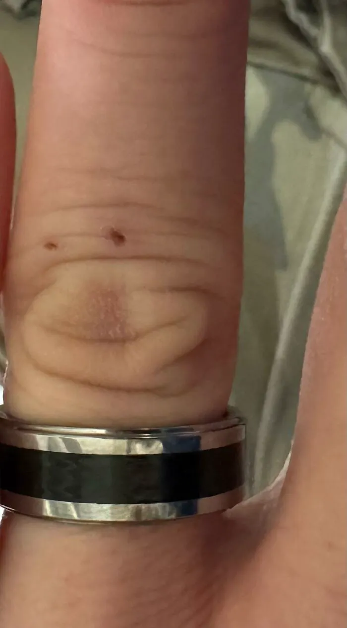 My Fiancé's Finger. He Has Two Little Booboos. Reminds Me Of Curious George