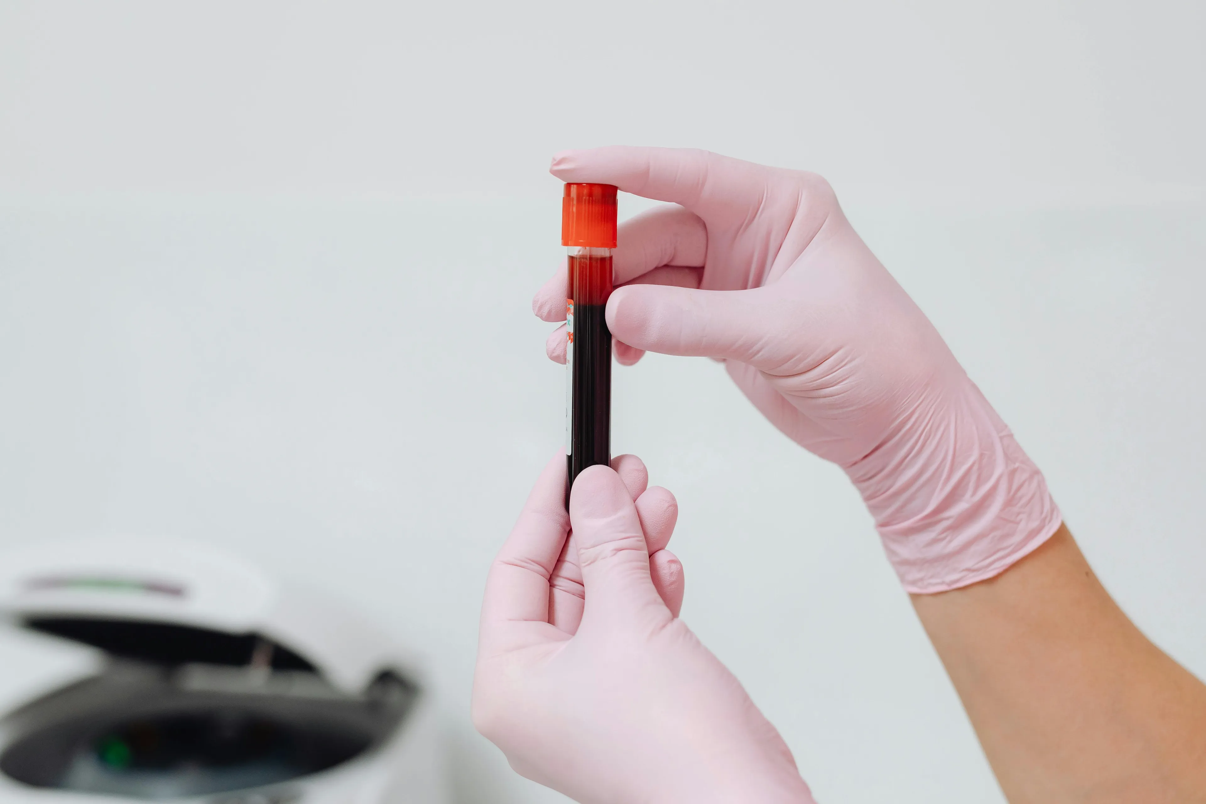 A physician in pink gloves holding a vial of blood testing clotting factor for clot formation science general knowledge.