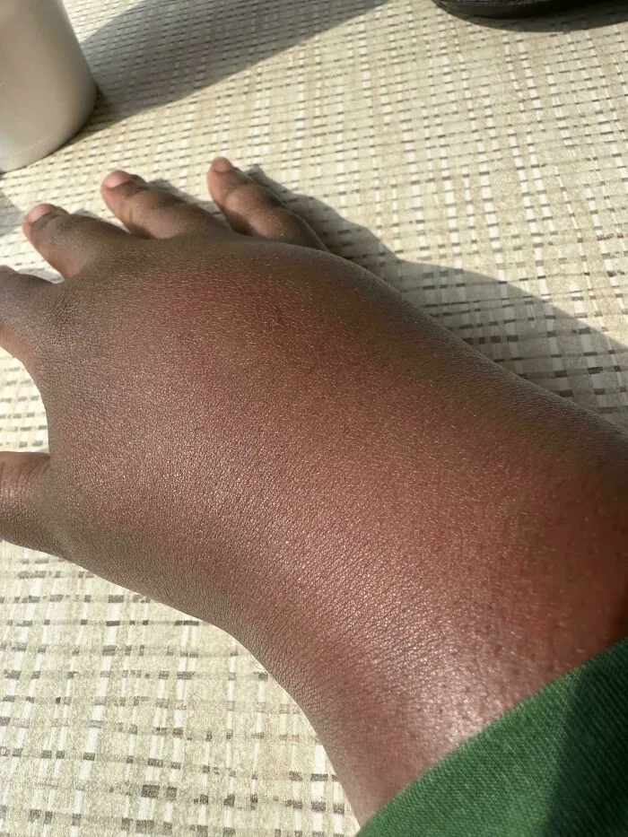 Cuando me picó una avispa durante un paseo y se me hinchó la piel en cuestión de minutos.