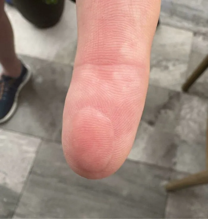 Mi tío se cortó la yema del dedo índice. El médico se la cosió al revés.