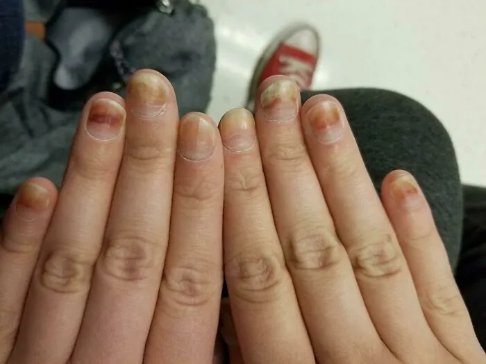 Mis uñas empujan la quimio fuera de las yemas de mis dedos