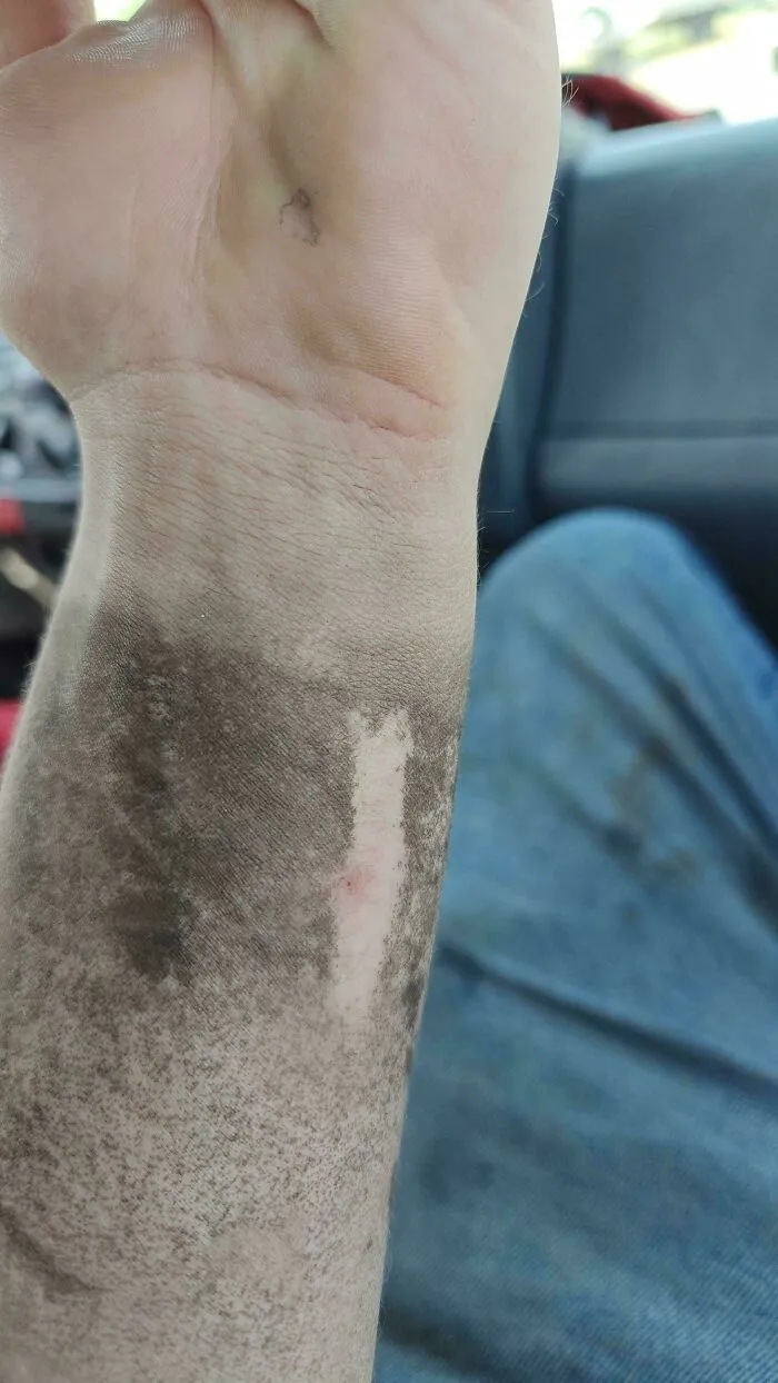 Una vieja cicatriz en mi brazo no se ensucia en el trabajo.