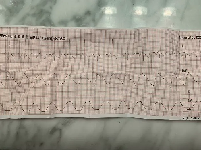 ECG and respiratory graph printout on medical paper, relating to strange autopsy findings that baffled doctors.