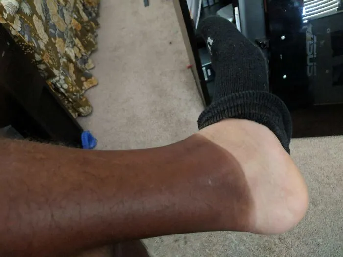 La diferencia entre piel bronceada y sin broncear desde la pierna hasta el pie.