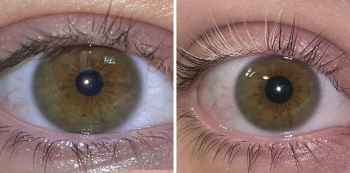 Hoy hace un año me di cuenta de que tenía una sola pestaña blanca y ahora es cerca del 20% de las pestañas de mi ojo derecho.