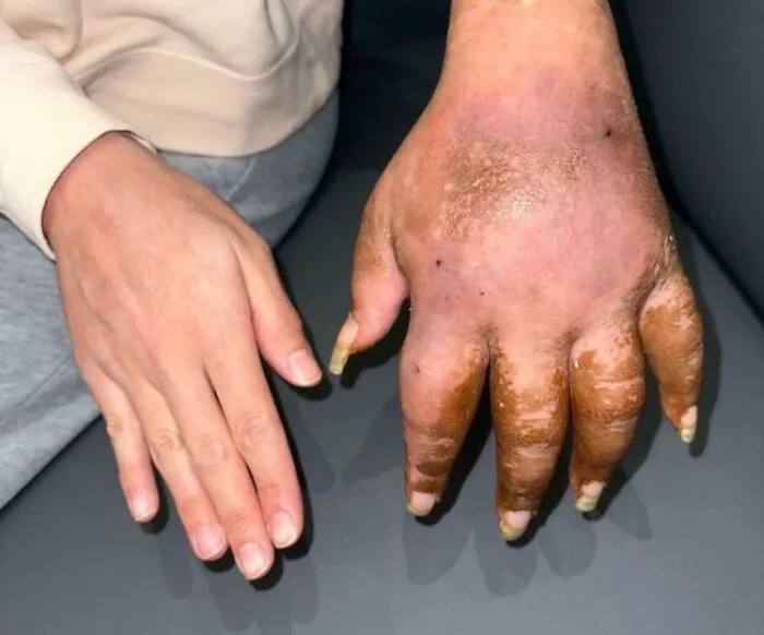 La mano de una paciente que ha sido diagnosticada con trastorno de CRPS