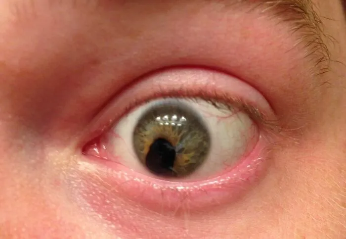Me clavaron una percha en el ojo hace 11 años.