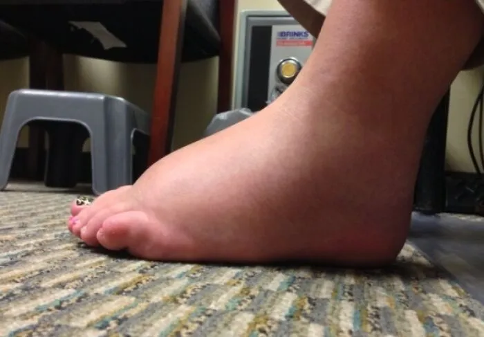 Hoy mi amiga embarazada tiene los pies un poco hinchados.