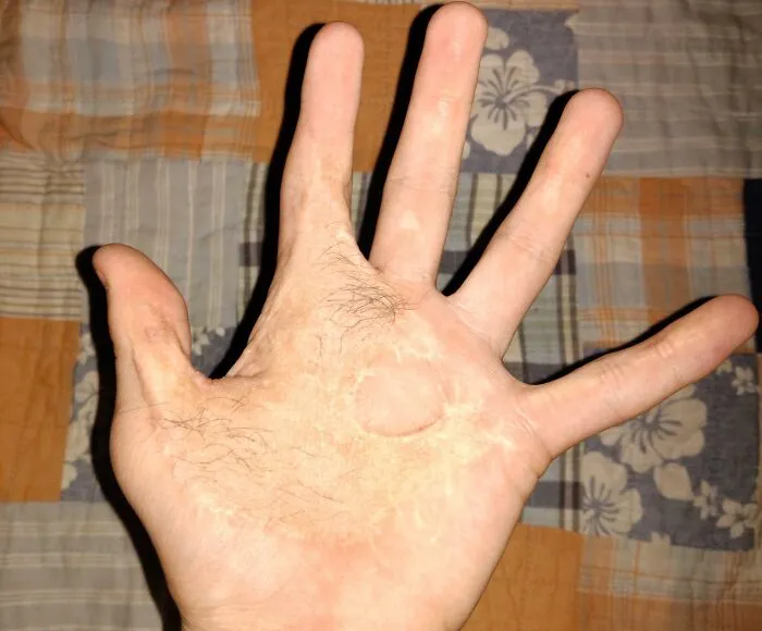 Me quemé la mano con una plancha a los 18 meses. Esta es mi mano casi 14 años después. Sí, eso es pelo en mi mano.