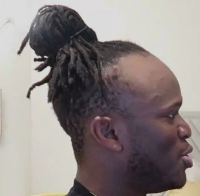 Man with severe hair thinning and dreadlocks tied in a bun showing a tragic hair accident from hairstylist error.