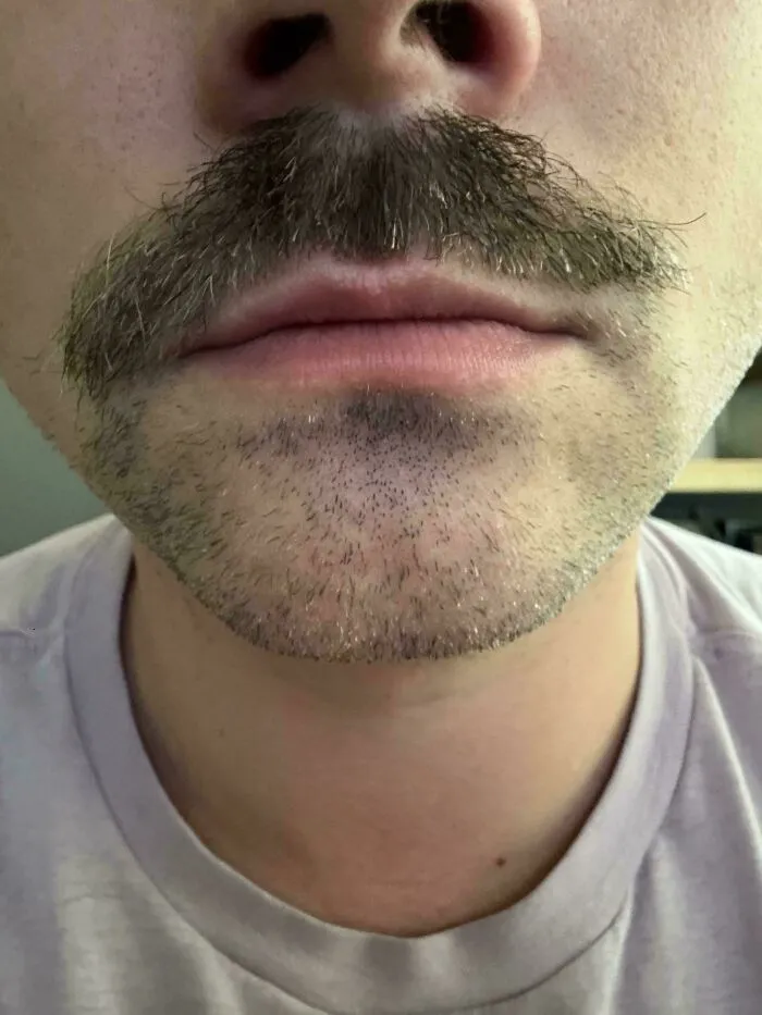 Close-up of a man's face showing a patchy, uneven mustache and facial hair after a tragic hair accident by a hairstylist.