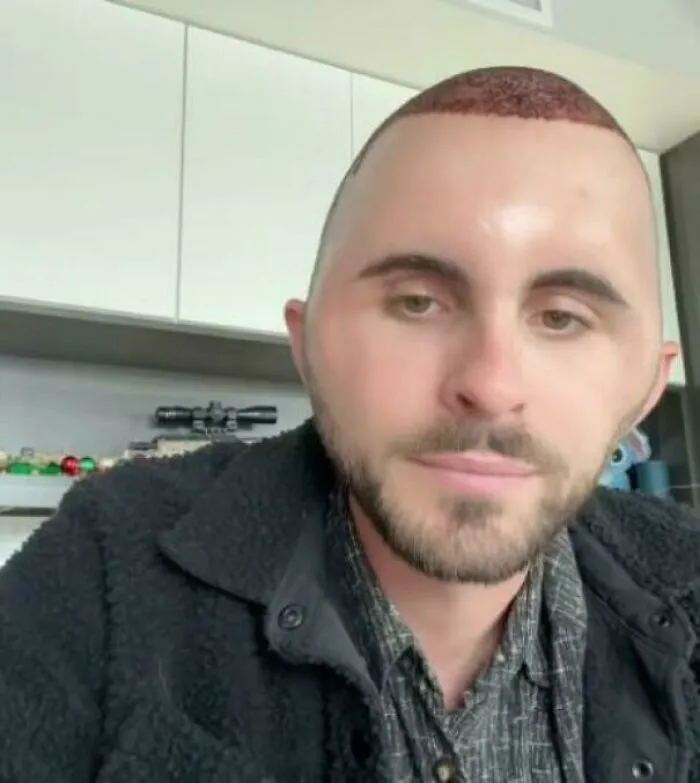Man with a patchy, uneven haircut after a tragic hair accident, highlighting hairstylist mistakes to avoid.