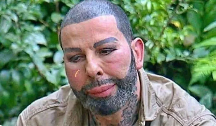 Man with uneven beard and eyebrow hair accident, sitting outdoors with greenery in the background, showing tragic hair mistakes