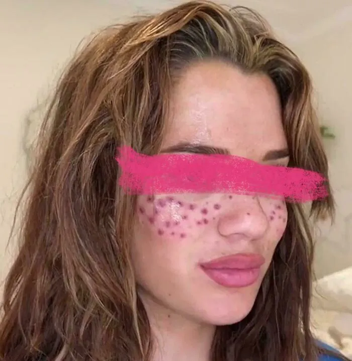 Influencer Gives Herself Freckles And Temp Blindness