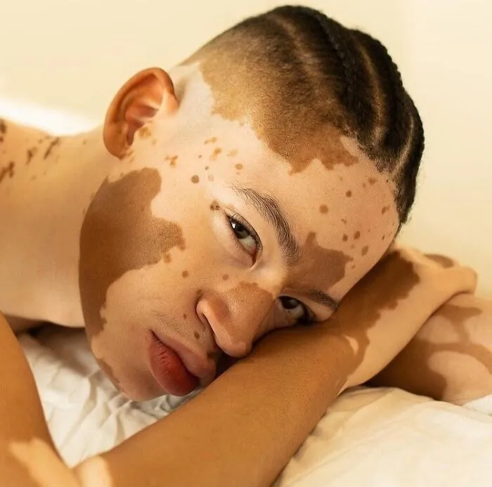 35 Breathtaking Photos Of People With Vitiligo That Redefine What Beauty Looks Like
