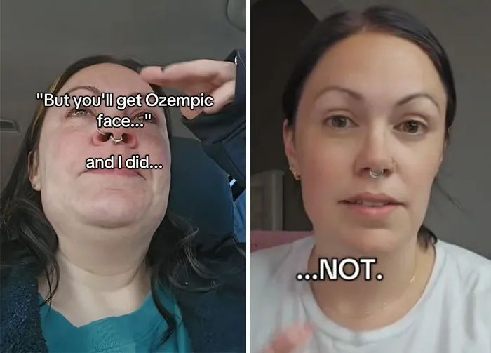 Before and after photos showing dramatic facial changes during an Ozempic journey, highlighting Ozempic face effects.