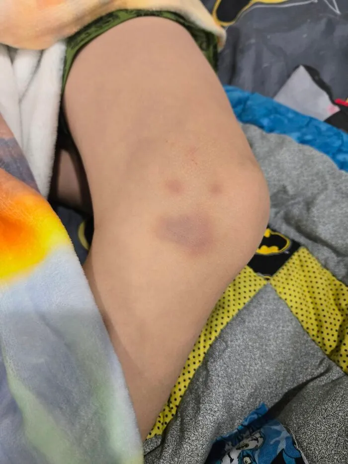 The Bruise On My Son's Knee