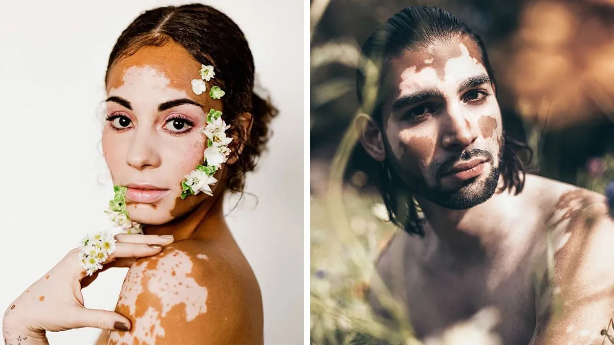 35 Breathtaking Photos Of People With Vitiligo That Redefine What Beauty Looks Like