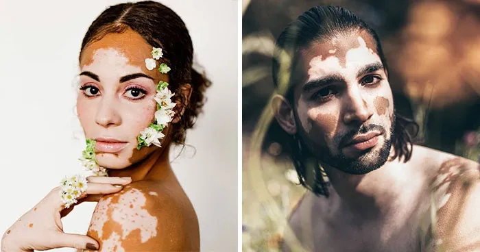 35 Breathtaking Photos Of People With Vitiligo That Redefine What Beauty Looks Like
