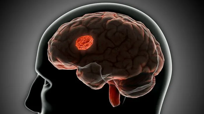 Human brain scan highlighting an abnormal mass, illustrating unusual autopsy findings that surprised medical professionals.