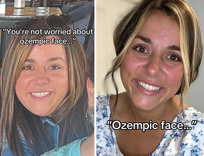 “I’ll Take Ozempic Face”: 77 People Share The Dramatic Facial Changes That Came With Their Ozempic Journey