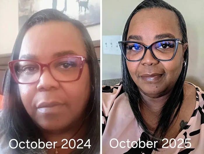 Before and after photos showing dramatic facial changes from an Ozempic face transformation over one year.
