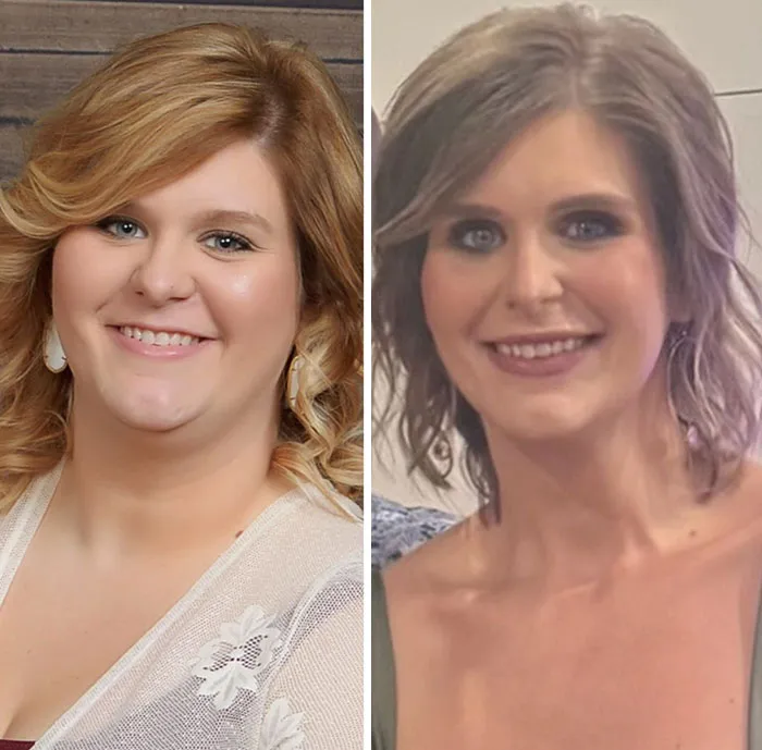 Before and after photos showing dramatic facial changes from the Ozempic face transformation journey.