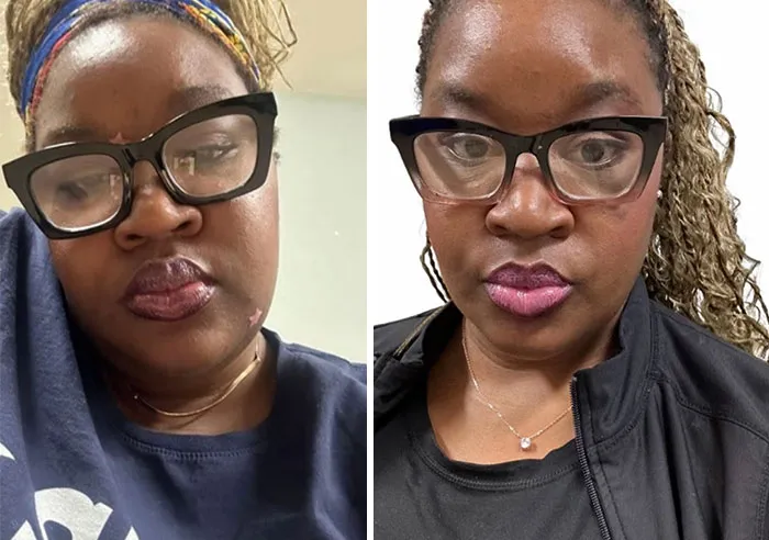 Before and after photos showing dramatic facial changes from Ozempic face on a woman wearing glasses.