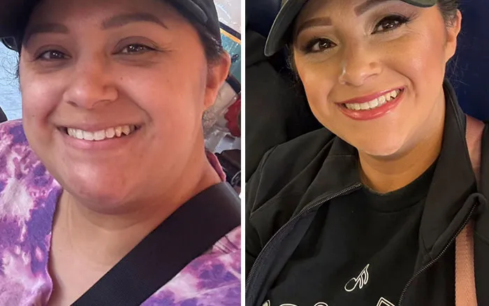 33 Personas comparten los drásticos cambios faciales que experimentaron durante su tratamiento con Ozempic