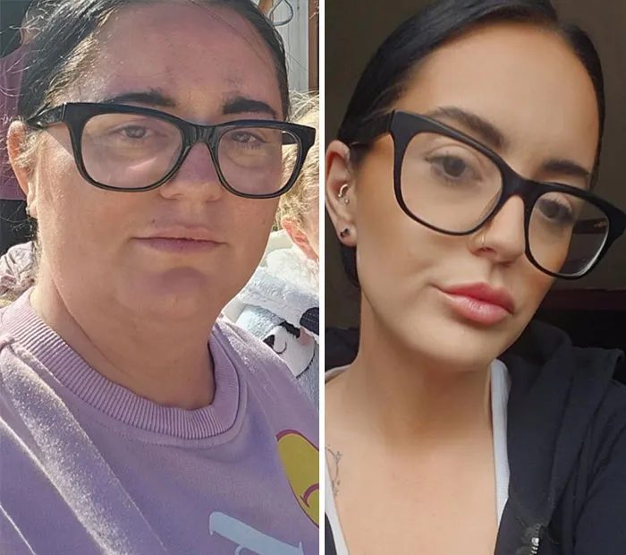 Before and after photos showing dramatic facial changes in a woman’s Ozempic journey with noticeable weight loss and slimming.
