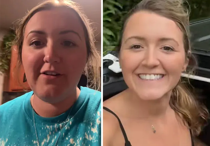 Side-by-side photos showing dramatic facial changes from the Ozempic face transformation journey.