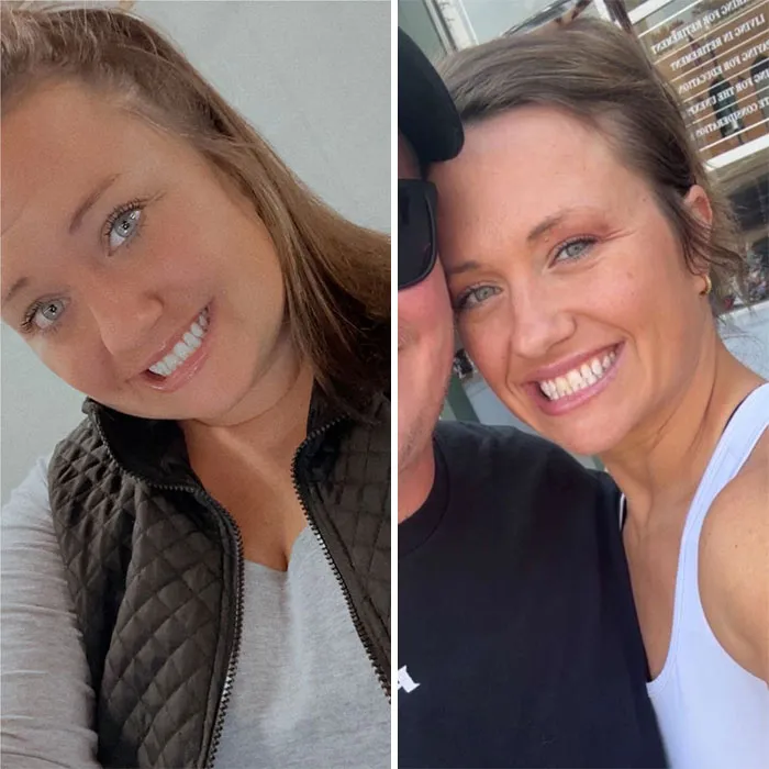 Before and after photos showing dramatic facial changes from Ozempic face during a weight loss journey.