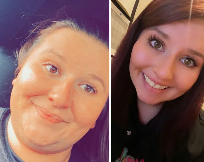Before and after photos showing dramatic facial changes in a woman’s Ozempic face journey and weight loss transformation.