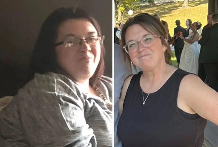 Before and after photos showing dramatic facial changes of a woman on her Ozempic journey experiencing Ozempic face.