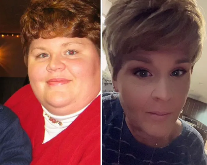 Before and after photos showing dramatic facial changes in a woman's Ozempic face transformation journey.