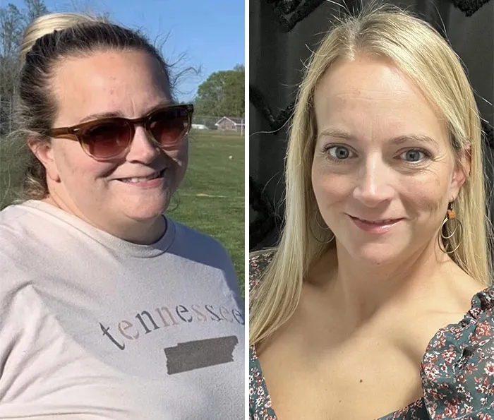 Before and after photos of a woman showing dramatic facial changes from her Ozempic journey and Ozempic face transformation.