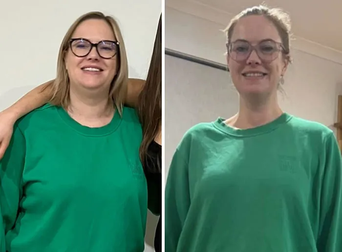 Before and after photos showing dramatic facial changes during the Ozempic face transformation journey.