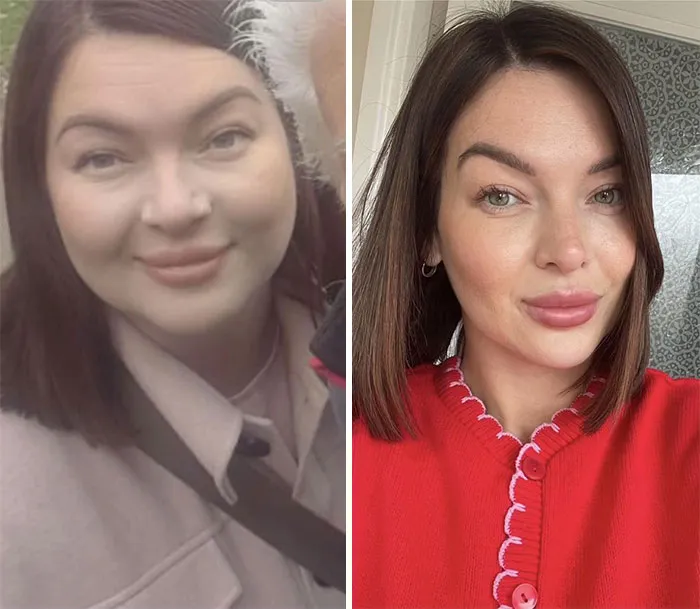 Side-by-side photos showing dramatic facial changes during an Ozempic journey with noticeable weight loss effects.