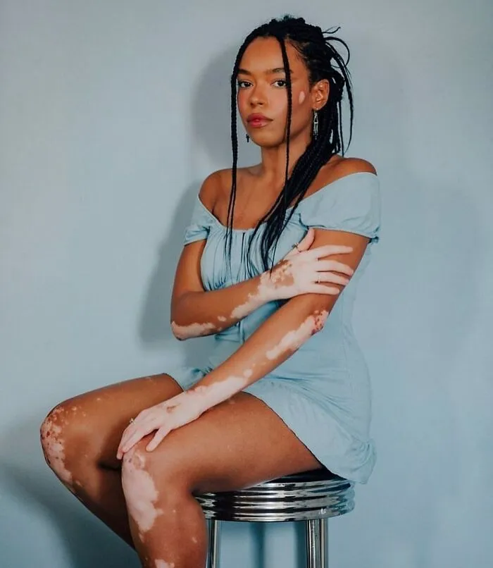 35 Breathtaking Photos Of People With Vitiligo That Redefine What Beauty Looks Like