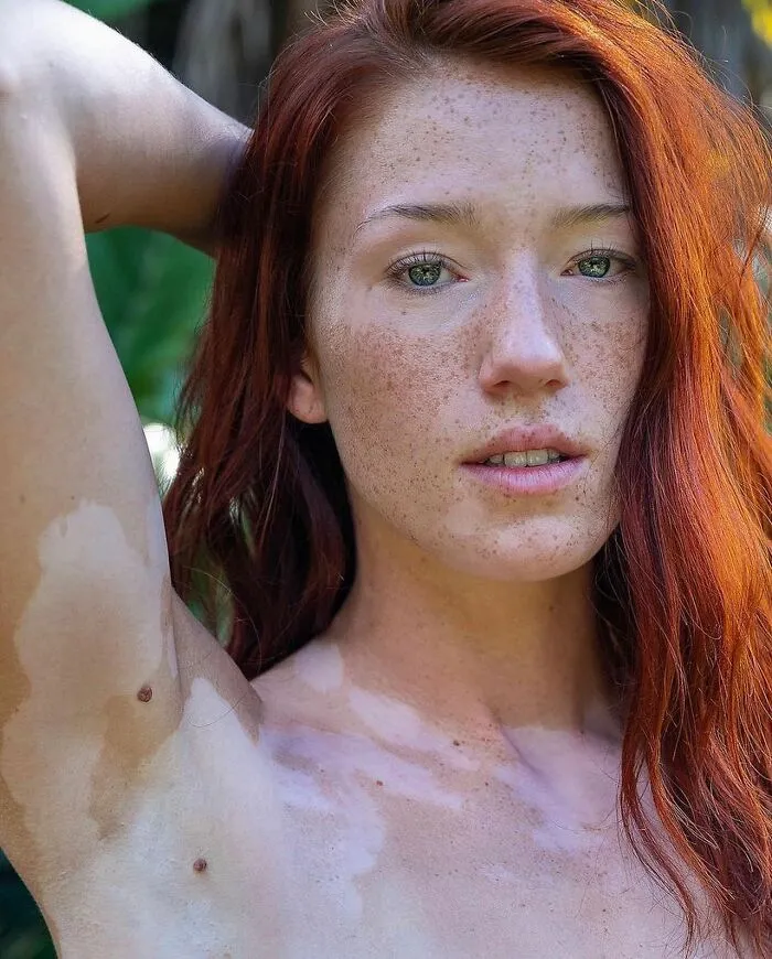 35 Breathtaking Photos Of People With Vitiligo That Redefine What Beauty Looks Like