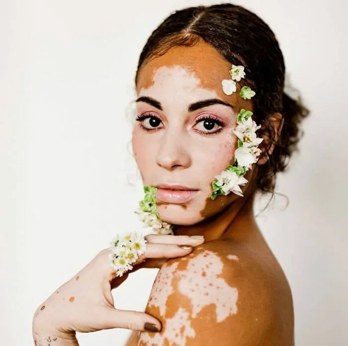 35 Breathtaking Photos Of People With Vitiligo That Redefine What Beauty Looks Like