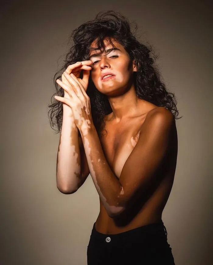 35 Breathtaking Photos Of People With Vitiligo That Redefine What Beauty Looks Like