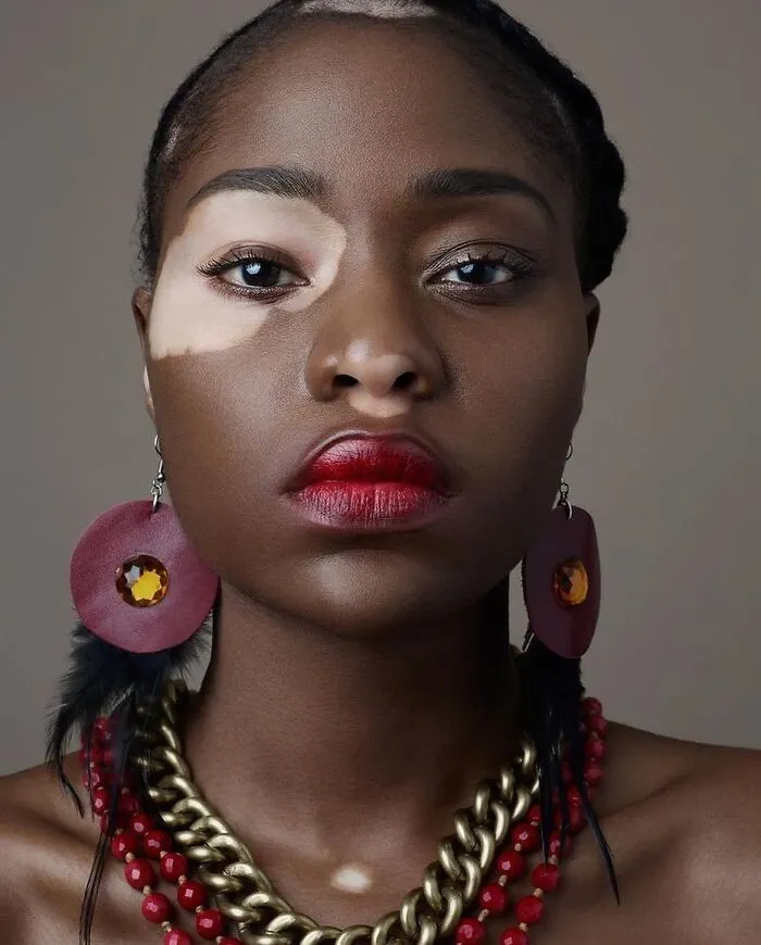 35 Breathtaking Photos Of People With Vitiligo That Redefine What Beauty Looks Like