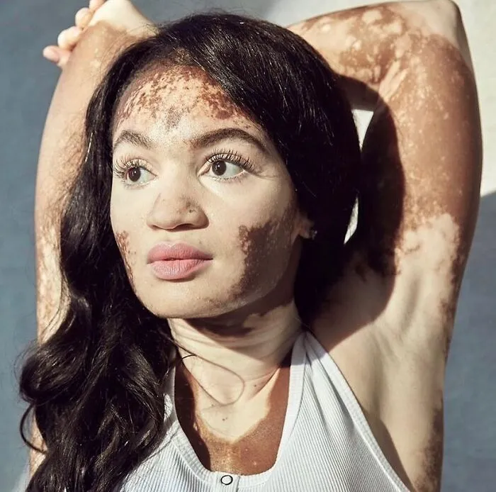 35 Breathtaking Photos Of People With Vitiligo That Redefine What Beauty Looks Like