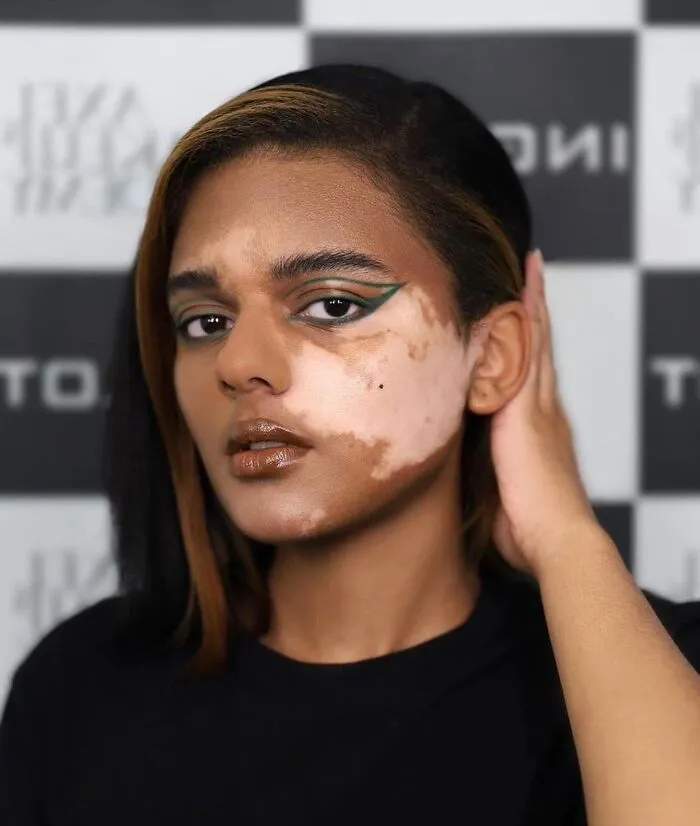 35 Breathtaking Photos Of People With Vitiligo That Redefine What Beauty Looks Like
