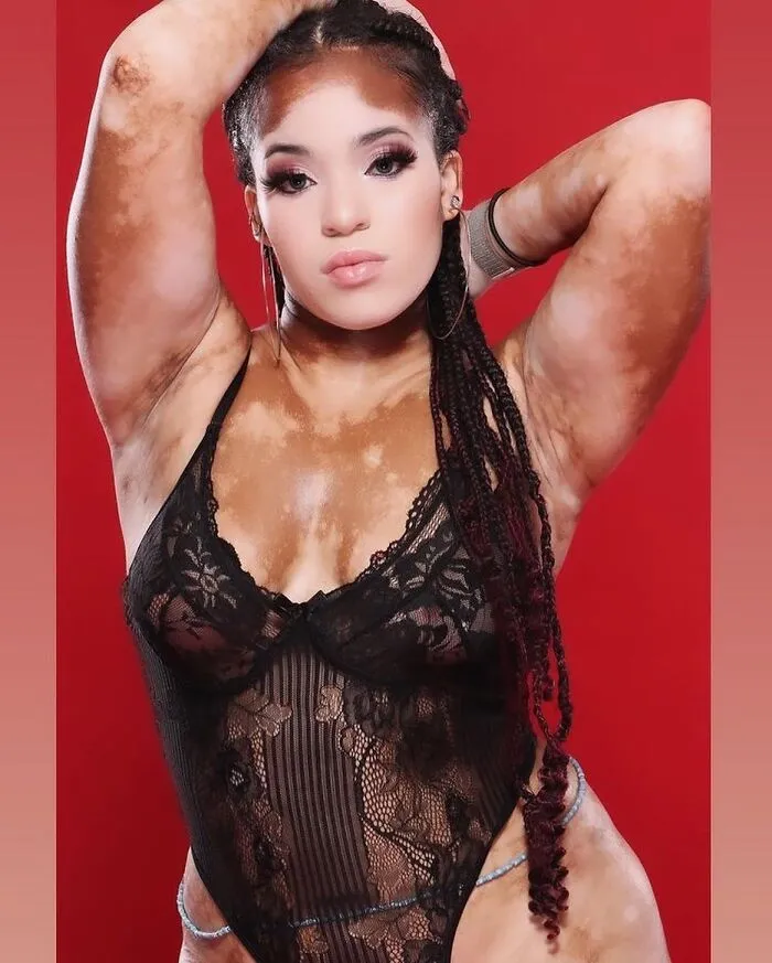 35 Breathtaking Photos Of People With Vitiligo That Redefine What Beauty Looks Like