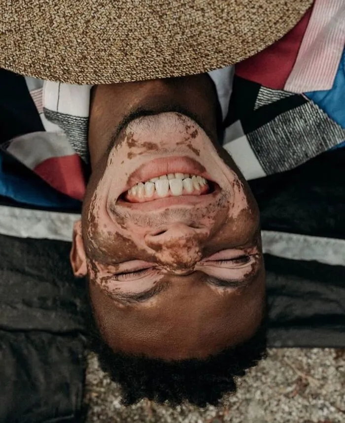 35 Breathtaking Photos Of People With Vitiligo That Redefine What Beauty Looks Like