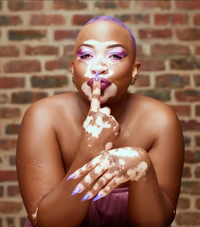 35 Breathtaking Photos Of People With Vitiligo That Redefine What Beauty Looks Like