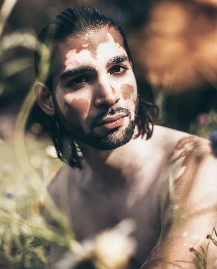 35 Breathtaking Photos Of People With Vitiligo That Redefine What Beauty Looks Like