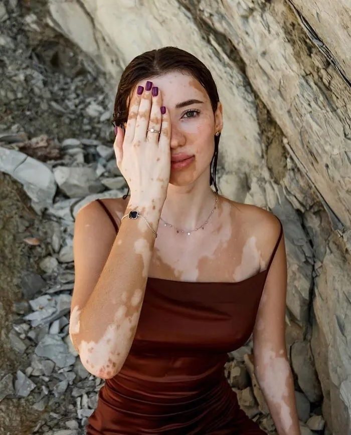 35 Breathtaking Photos Of People With Vitiligo That Redefine What Beauty Looks Like